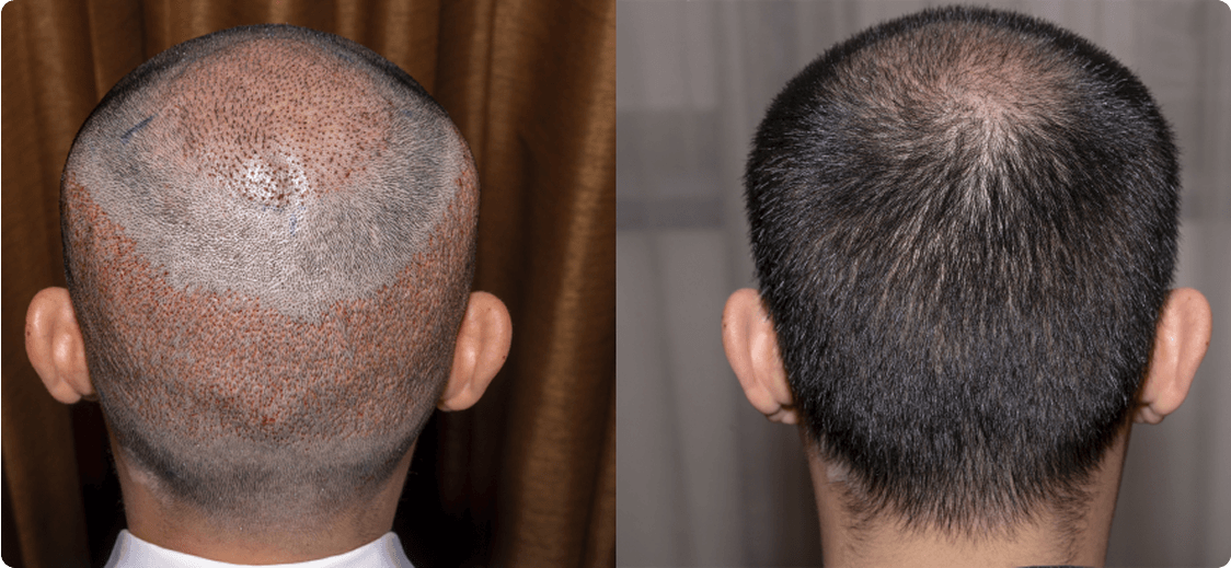 Hair Transplant in Bangalore