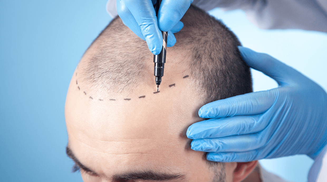 Everything You Must Know Before Getting a Hair Transplant in Bangalore