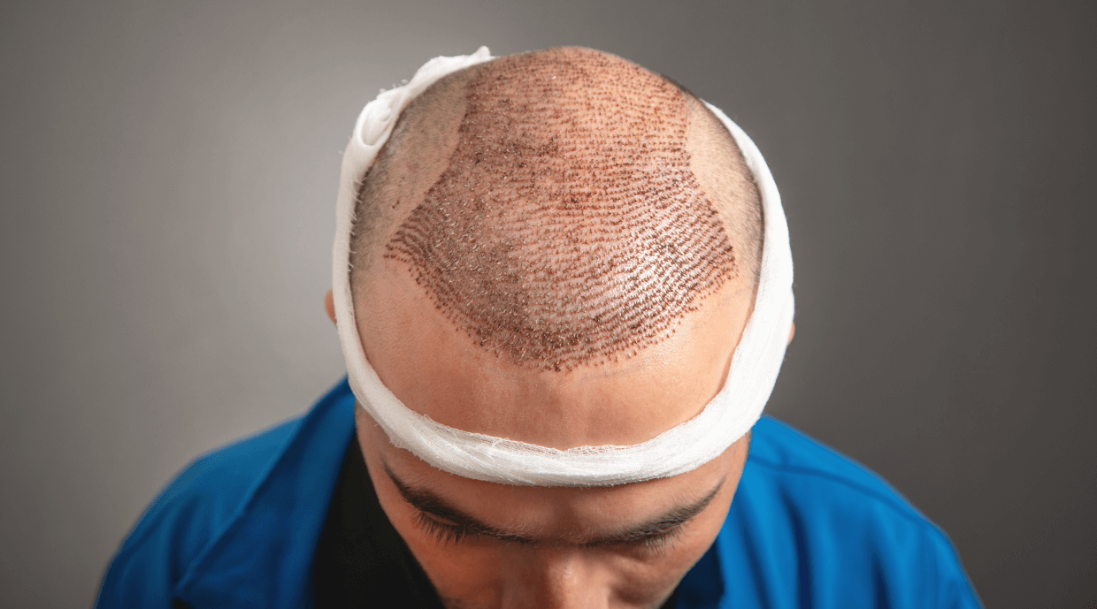 What is the Hair Transplant, how does it work and procedure?