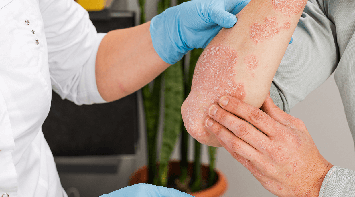 Psoriasis Treatment Bangalore – Effective Solutions and Care Tips