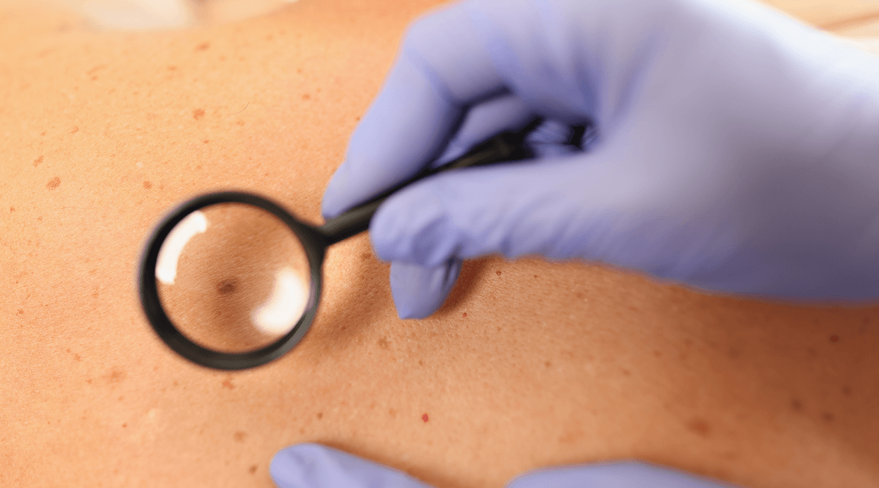 Skin Tag Removal – Causes and Treatment Options