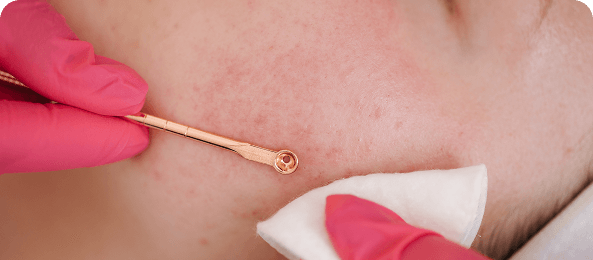 MediFacial Treatment