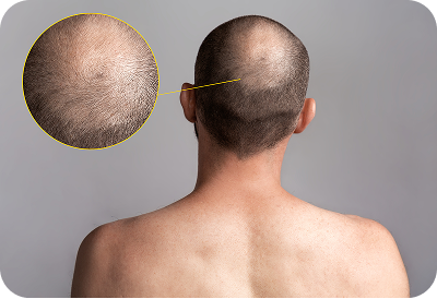 hair-loss-treatment-img