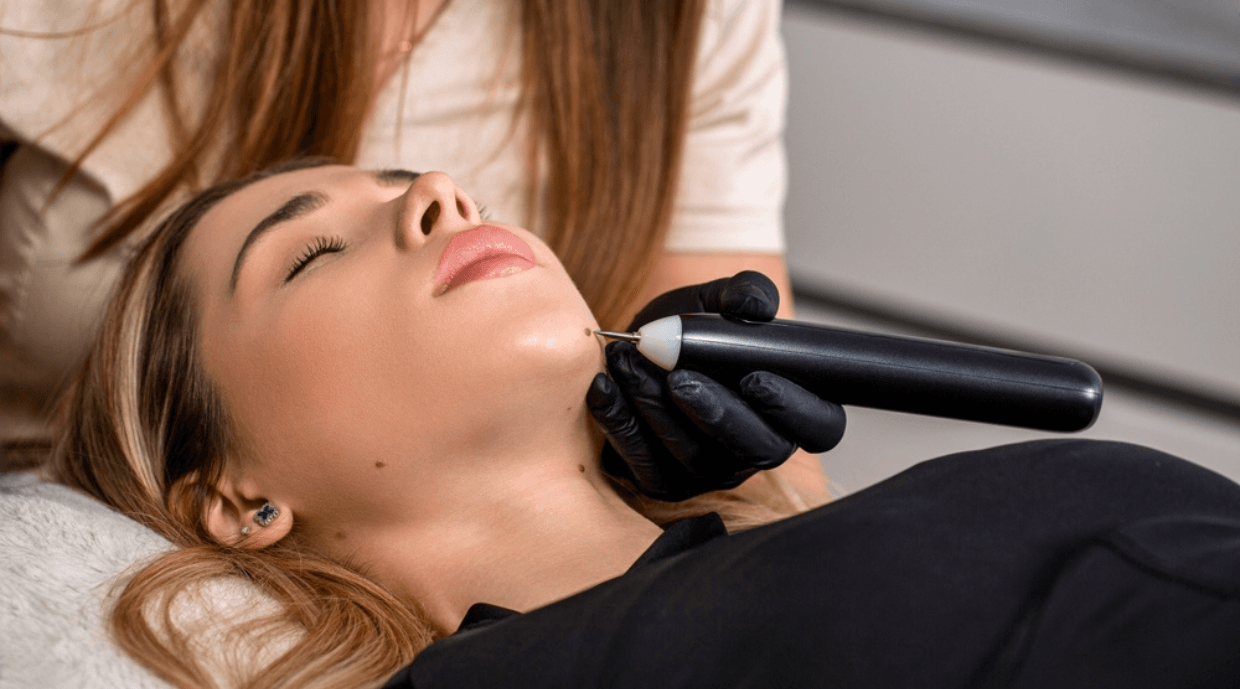 Is Mole Removal Safe? Everything You Should Know Before Treatment